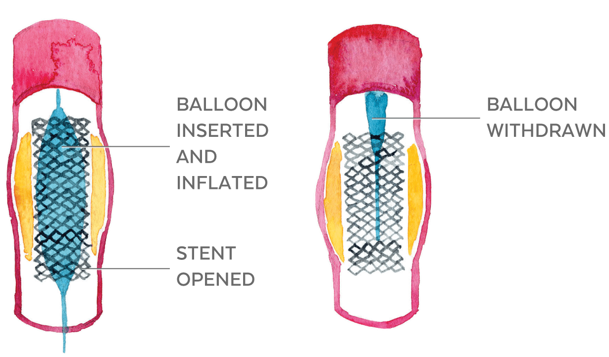 Illustration of the stent and inflated balloon in the artery and the balloon being removed.