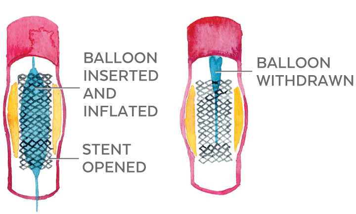 Illustration of the stent and inflated balloon in the artery and the balloon being removed.