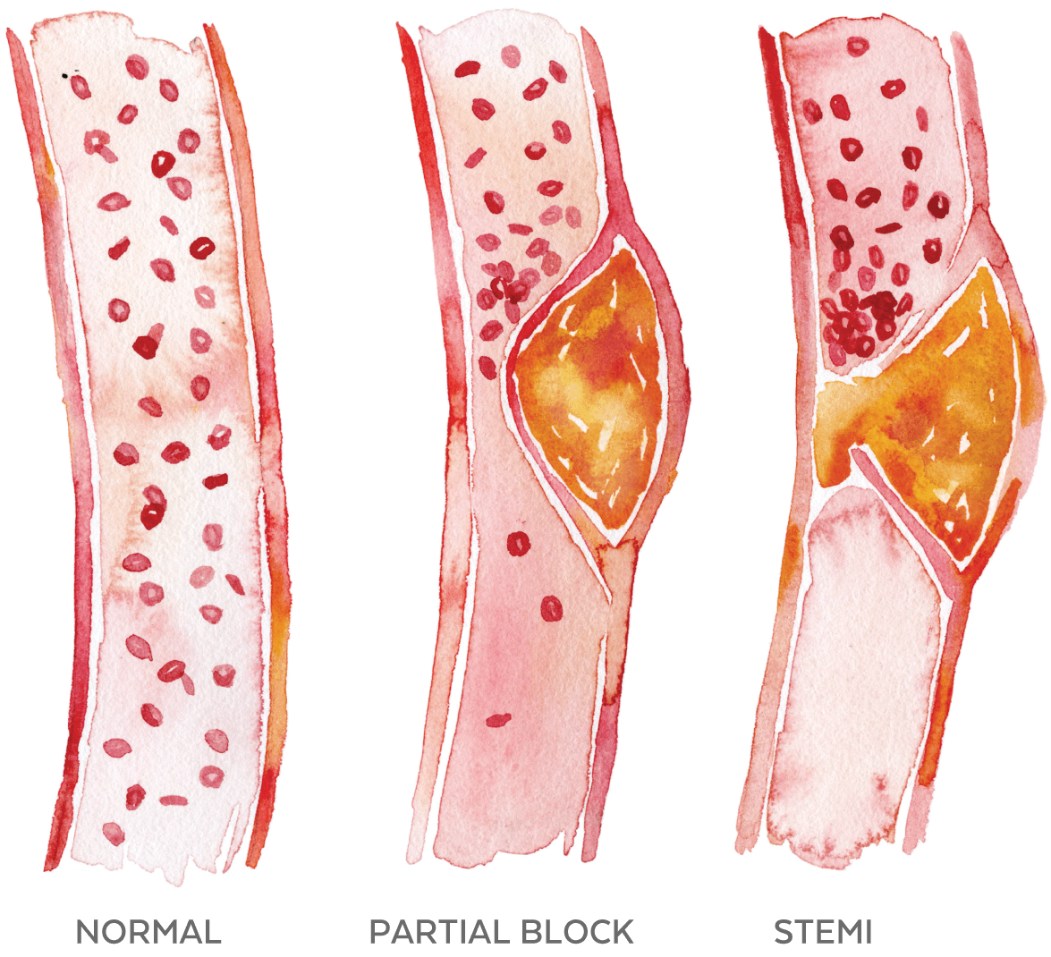 Illustration of a normal artery, a partially blocked artery, and a blocked artery.