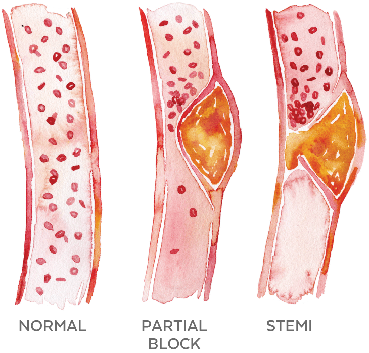 Illustration of a normal artery, a partially blocked artery, and a blocked artery.