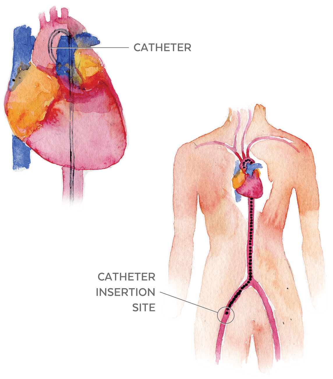 Illustration of the heart with a catheter inserted and where the catheter is inserted.