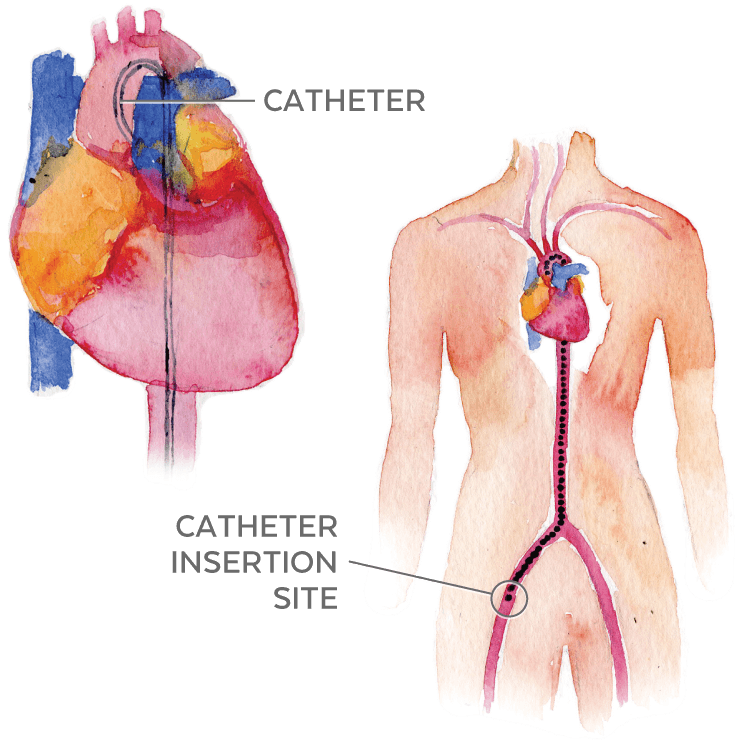 Illustration of the heart with a catheter inserted and where the catheter is inserted.