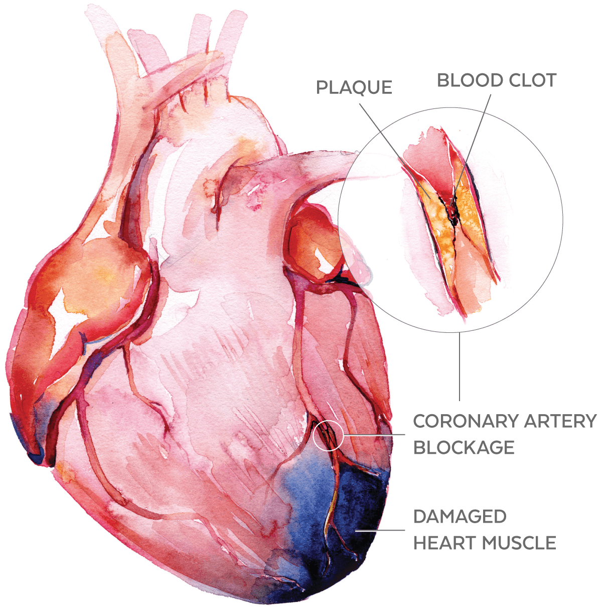 Illustration of plaque buildup in the heart.