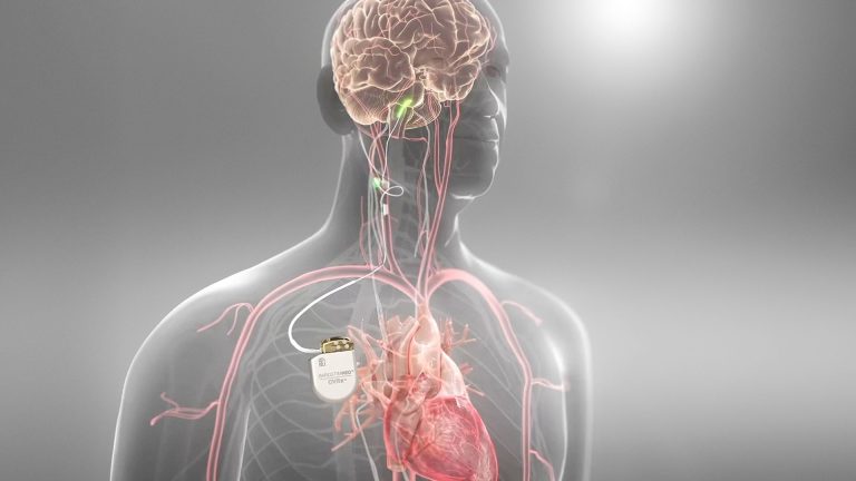 Visualization of the Barostim device implanted next to the heart.