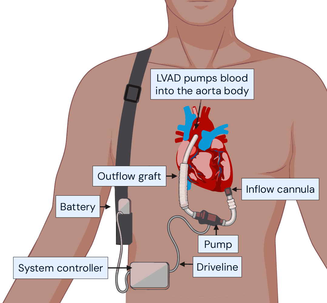 Infographic illustrating an LVAD system, showing components like the pump, inflow/outflow grafts, and system controller.